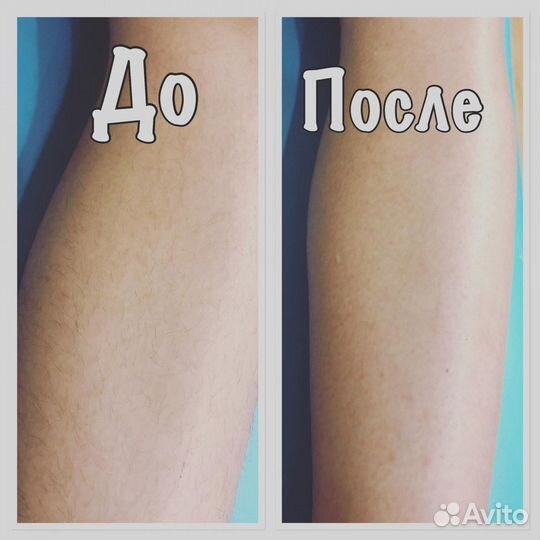 Шугаринг
