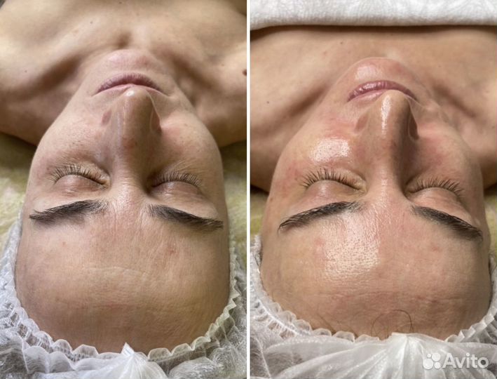 Комплексная Чистка Лица и Биоревитализация