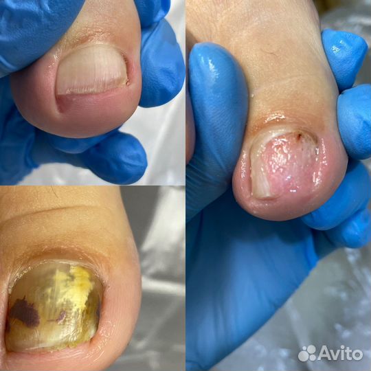 Подолог с выездом на дом