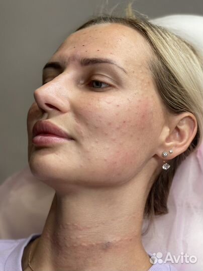 Увеличение губ / Косметолог