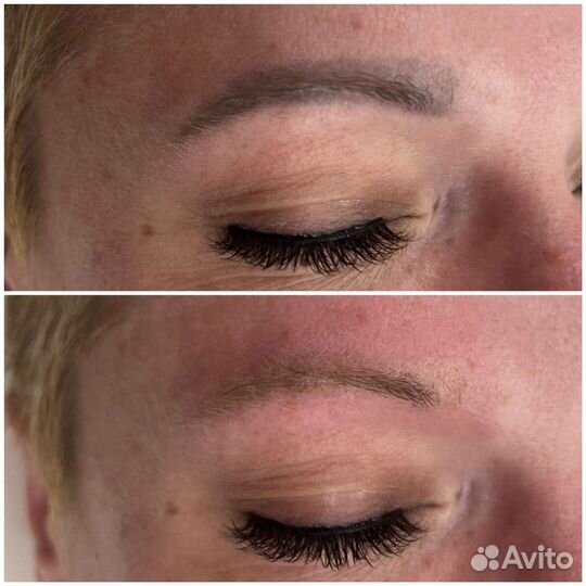 Удаление татуировок