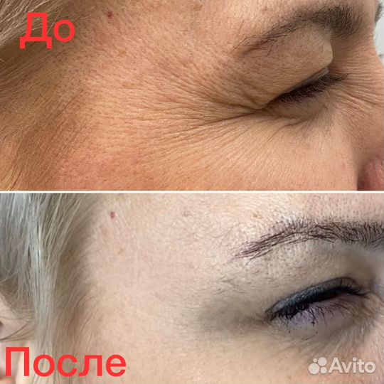 Инъекции, ботокс лица, губ, межбровье, лоб