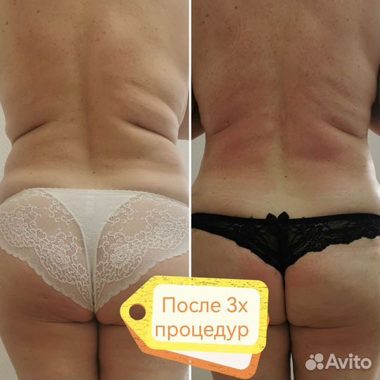 Аппаратный массаж /снижение веса, коррекция фигуры