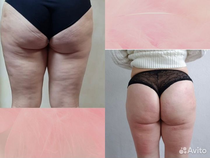 Массаж / Антицеллюлитный массаж / LPG – массаж