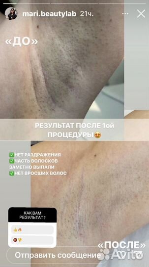 Лазерная эпиляция: подмышки