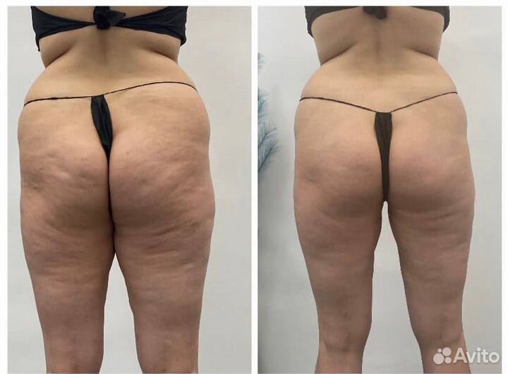 Гидромассаж похудение