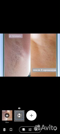 Электроэпиляция