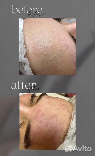 Комбинированная чистка лица