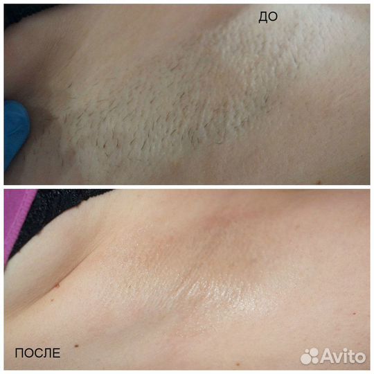 Spa-шугаринг