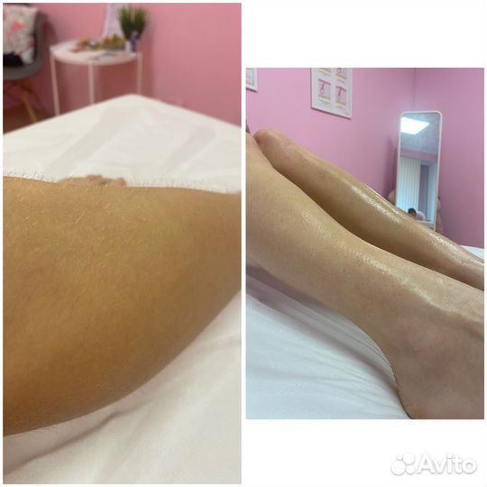 Шугаринг: глубокое бикини