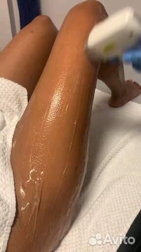 Лазерная эпиляция