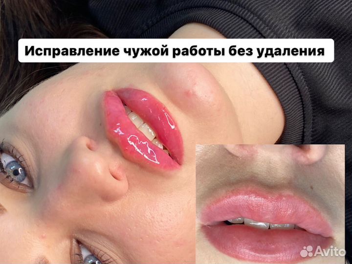 Увеличение губ без боли