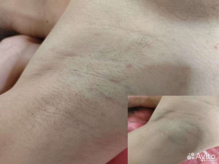 Депиляция воском: глубокое бикини