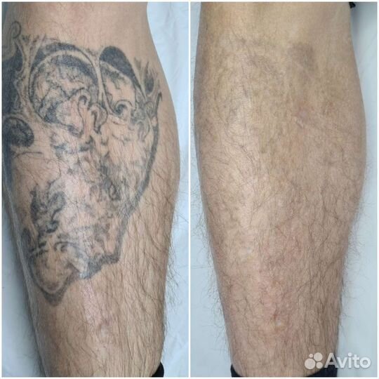 Удаление тату и татуажа