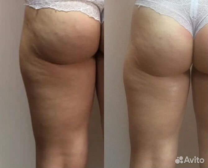 Аппаратная коррекция фигуры