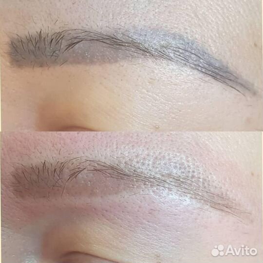 Лазерное удаление тату и татуажа