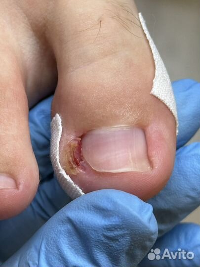 Вросший ноготь
