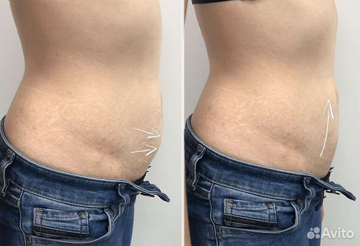 Смас-лифтинг Ультраформер