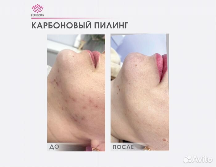 Карбоновый пилинг