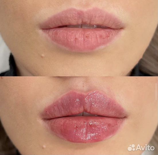 Увеличение губ