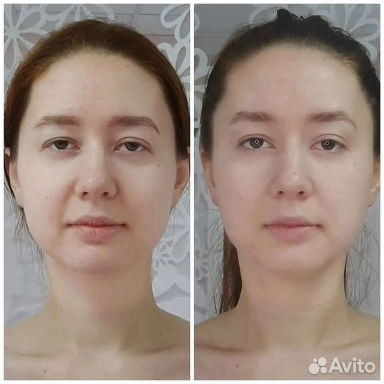 Лифтинг лица. Витапластика/Омоложение