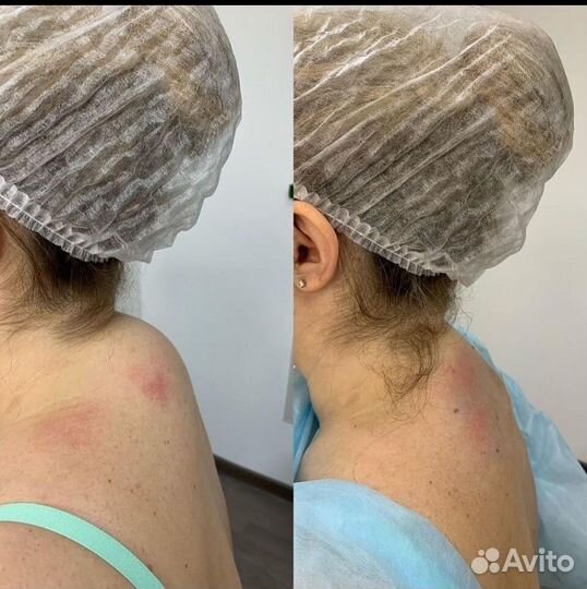 Ботокс