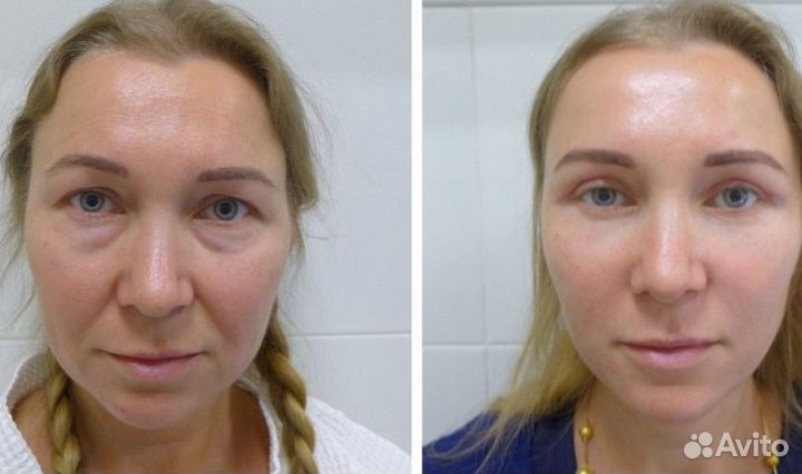 Лифтинг+Буккальный массаж лица