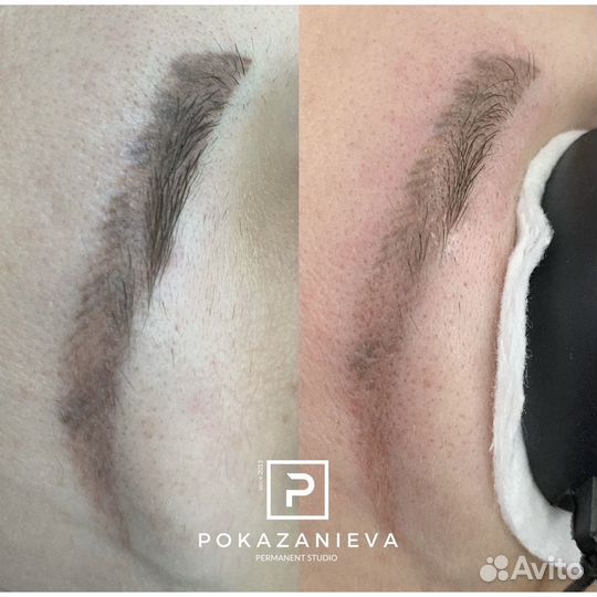 Удаление тату, татуажа бровей губ глаз