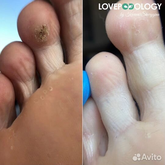 Подолог/бородавки/медицинский педикюр