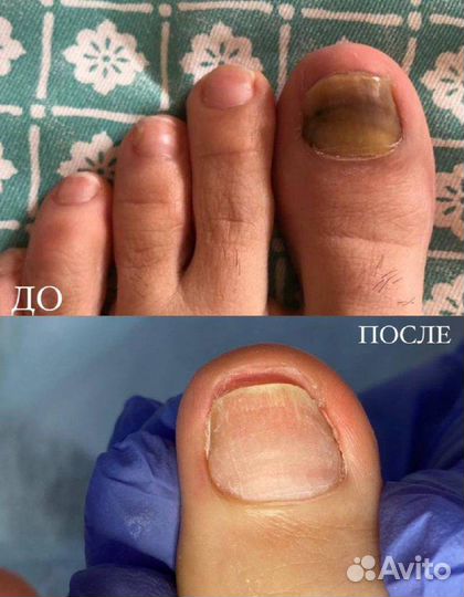 Врач подолог, медицинский педикюр