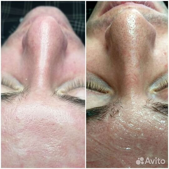 Комбинированная чистка лица