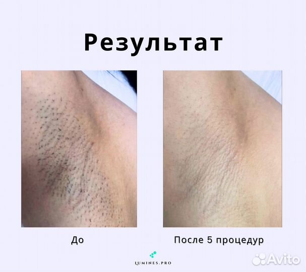 Диодный лазер Люминес максван 1200W