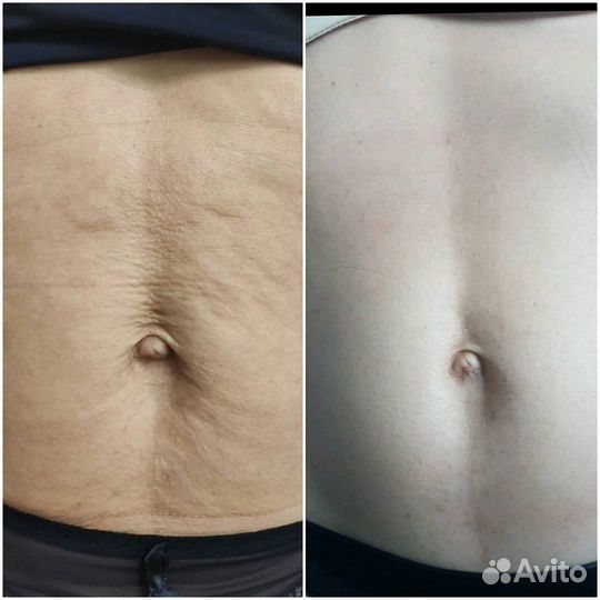 Рф-лифтинг тела