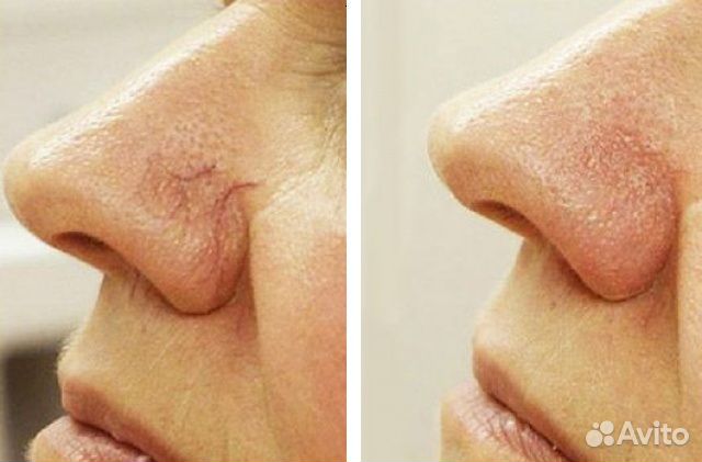 Удаление купероза, сосудистых звездочек, розацеа