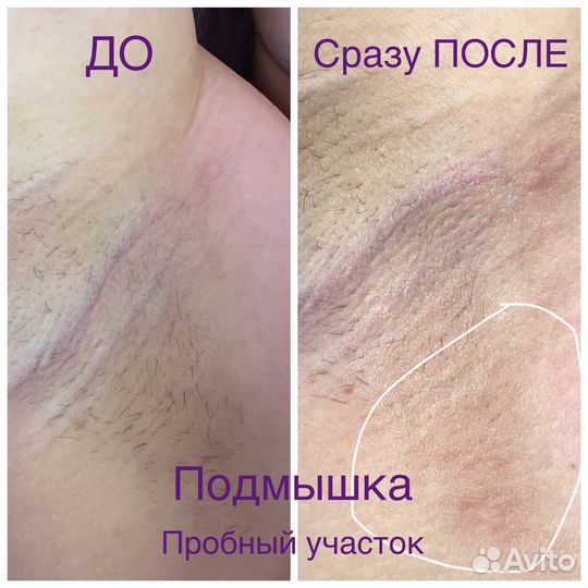 Электроэпиляция