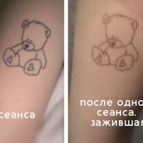 Лазерное удаление тату любой сложности, Солнечногорск