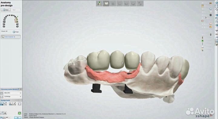 Hyperdent/3shape/ExoCad/3Diagnosys PlastyCad