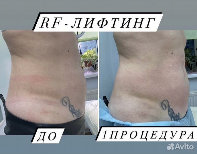 Аппаратная коррекция фигуры