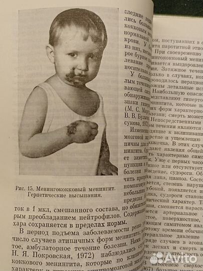 Менингиты и энцефалиты у детей. Цукер. 1975