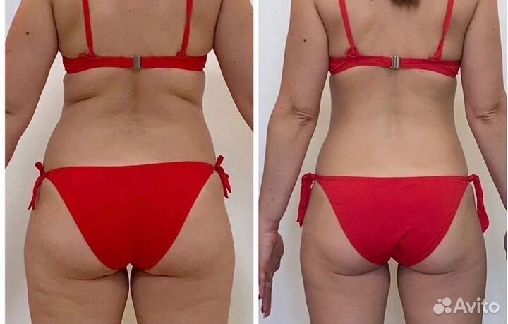 LPG массаж vela Shape