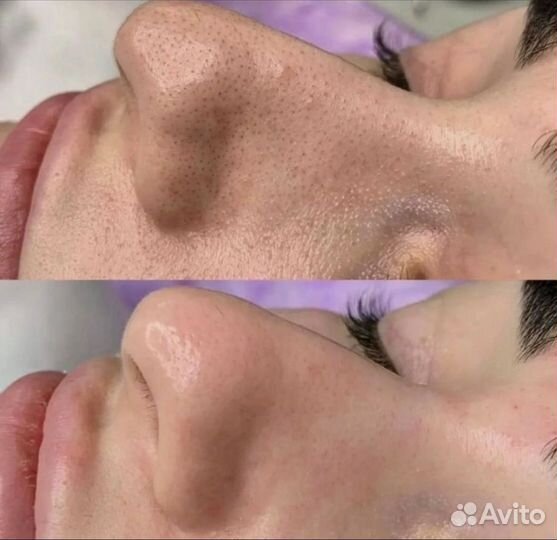 Чистка лица, пилинги, биоревитализация