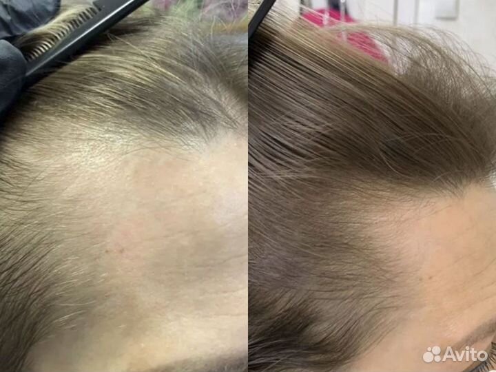 Лечение волос / пилинг / трихолог