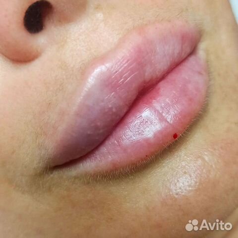 Инъекции ботокса в лоб
