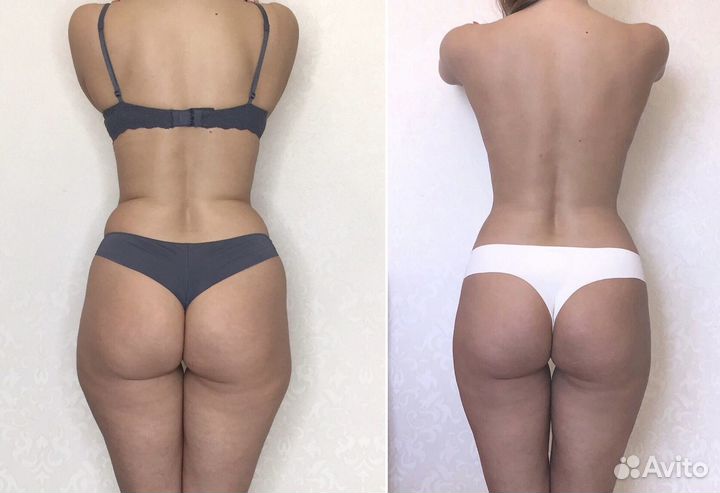 Антицеллюлитный аппаратный массаж