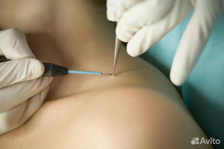 Удаление папиллом, милиумы, камедоны