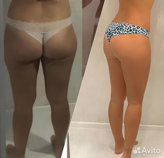 Криолиполиз LPG массаж Коррекция фигуры