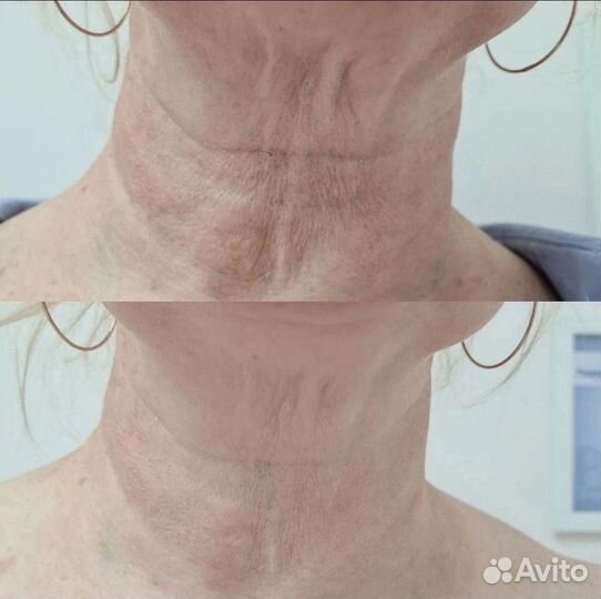 Холодная плазма омоложение лица и тела