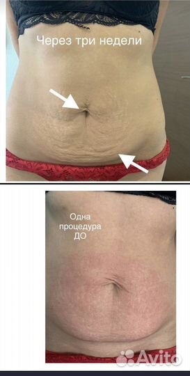 Удаление растяжек живот