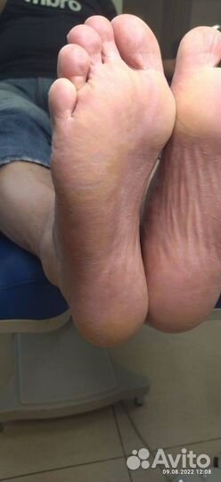 Бесплатный педикюр - решаем сложные случаи