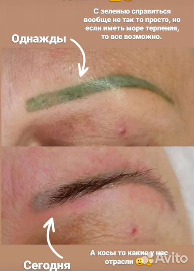 Удаление татуировок и татуажа